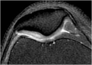 Lesión de grado I en el cartílago rotuliano. Se aprecia una vesiculación hiperintensa en el espesor del cartílago (área izquierda la imagen).