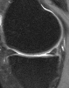 Lesión de grado II en el cartílago troclear. Se aprecia irregularidad (forma dentada) en la superficie del cartílago (parte central de la imagen).
